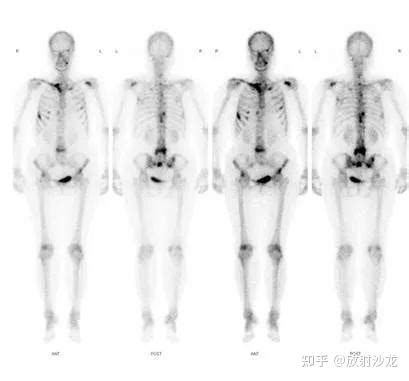 癌症火化骨頭|肿瘤无法火化掉吗？